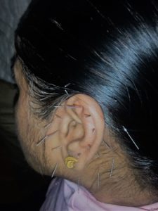 Acupunture-Hijama-chennai-Treatment3-225x300-1
