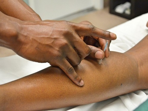 acupuncture-chennai